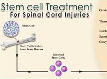 Paraspinal-Stem-Cell-Treatment