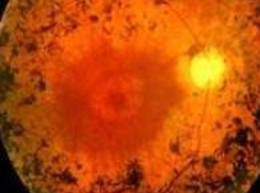 Retinitis-Pigmentosa-5